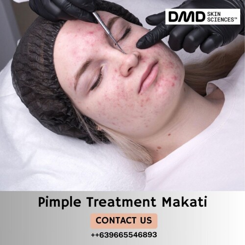 Effective-Pimple-Treatment-Clinics-Makati.jpg